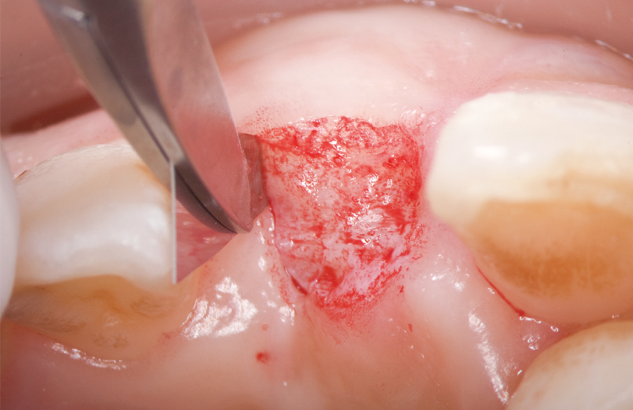 インプラント・歯周外科1