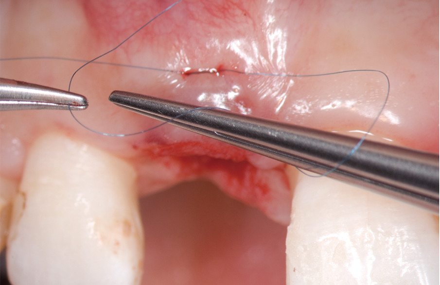 インプラント・歯周外科2