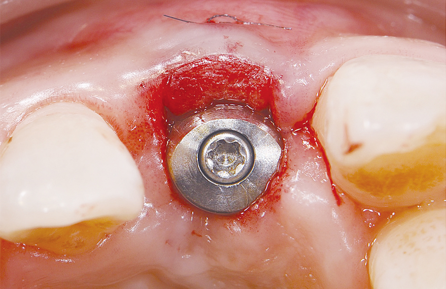インプラント・歯周外科3