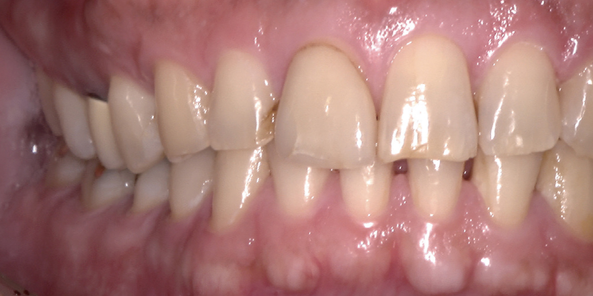 深部にも有効な明るさと深い被写界深度