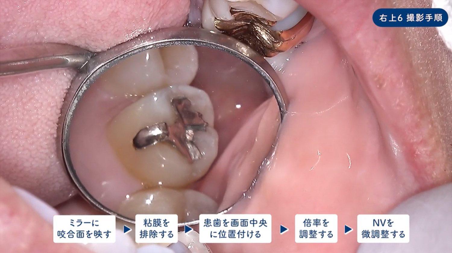 上顎大臼歯部撮影ポジション