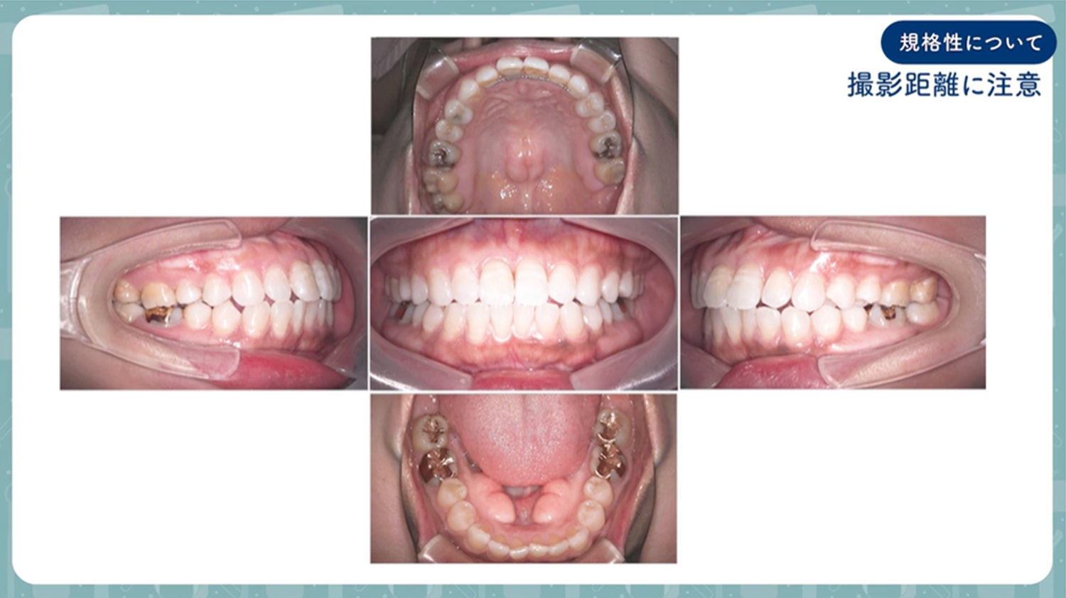 口腔内写真5枚法撮影手順
