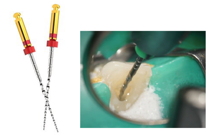 デントクラフト REファイル