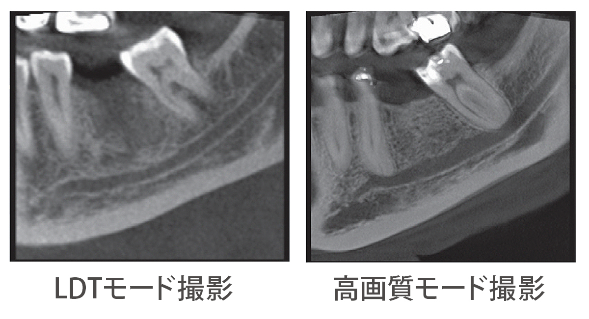 Low Dose Technology™ LDT  超低被ばく撮影モード搭載