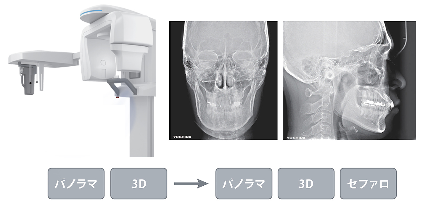 セファロアップグレード