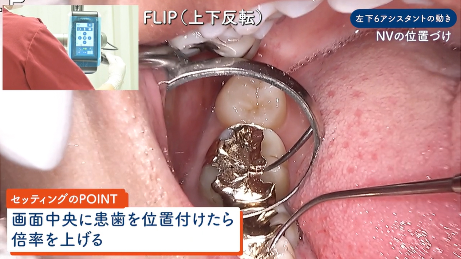 下顎大臼歯部撮影ポジション